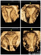 婦科超聲利器！超聲醫學科專家：經陰道三維彩超 精準診斷婦科疾病