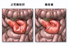 什么是急性腸套疊？徐州兒科專家詳解兒外科常見的急腹癥