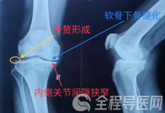 骨關節炎的發病因素有哪些？徐州康復醫院為你科普